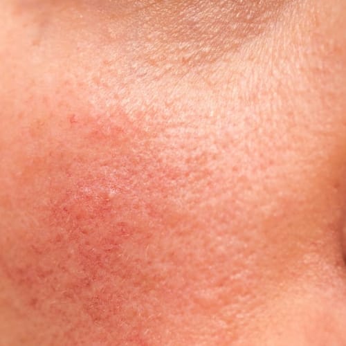 Combination Skin