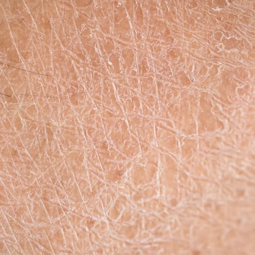 Dry Skin